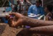 CDC: Mpox is out of control in Africa