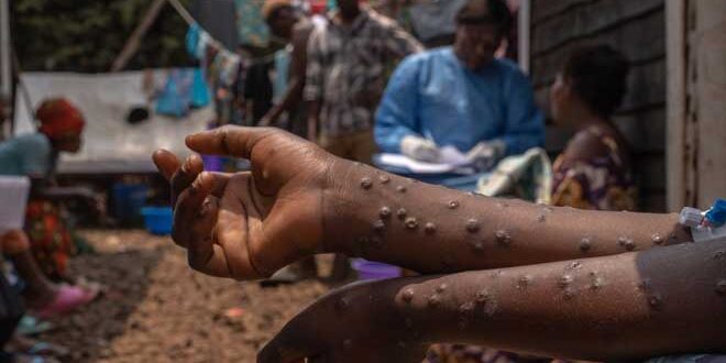 CDC: Mpox is out of control in Africa